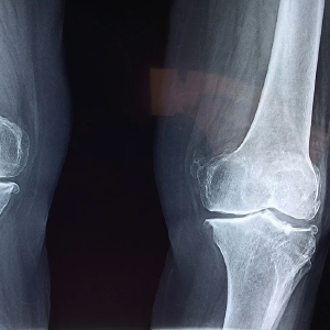 Personal Injury Lawyers